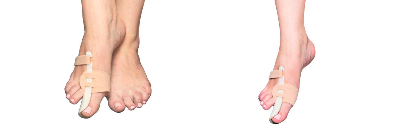 Как убрать косточку на ноге: лечение вальгусной деформации без хирургии