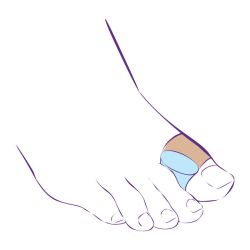 СТ-54.4 Межпальцевая перегородка с петлей СТ-54.4 Межпальцевая перегородка с петлей