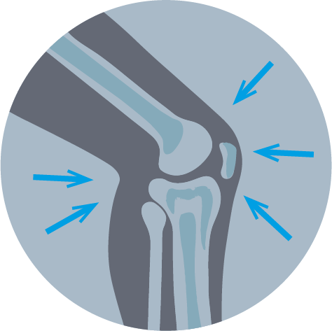 Улучшенная стабилизация сустава Улучшенная стабилизация сустава
