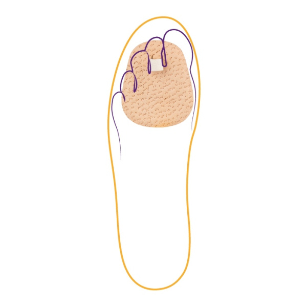 Корректор одного пальца СТ-221  Trives Корректор одного пальца СТ-221  Trives